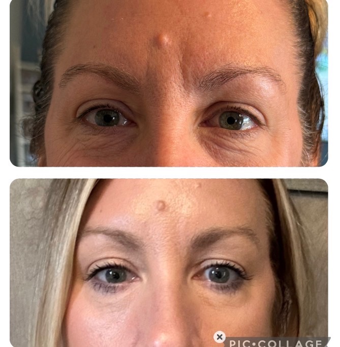 Before and after neurotoxin treatment results at TRU Integrative Wellness
