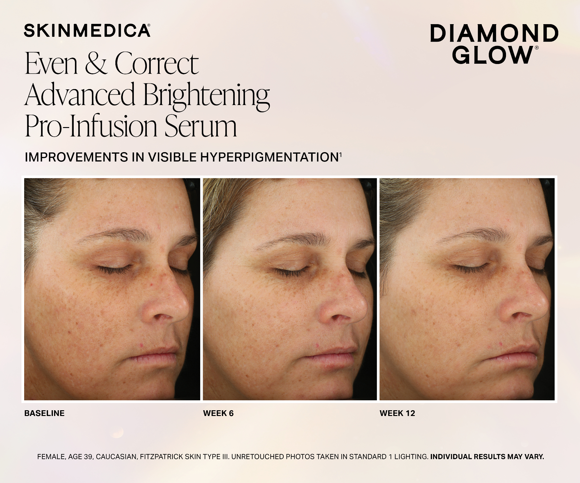 DiamondGlow with SkinMedica Even & Correct Advanced Brightening Pro-Infusion Serum — before and after photos showing reduced hyperpigmentation at baseline, week 6, and week 12
