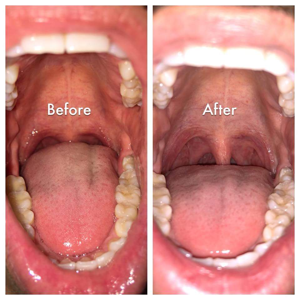 NightLase snoring treatment at TRU Integrative Wellness