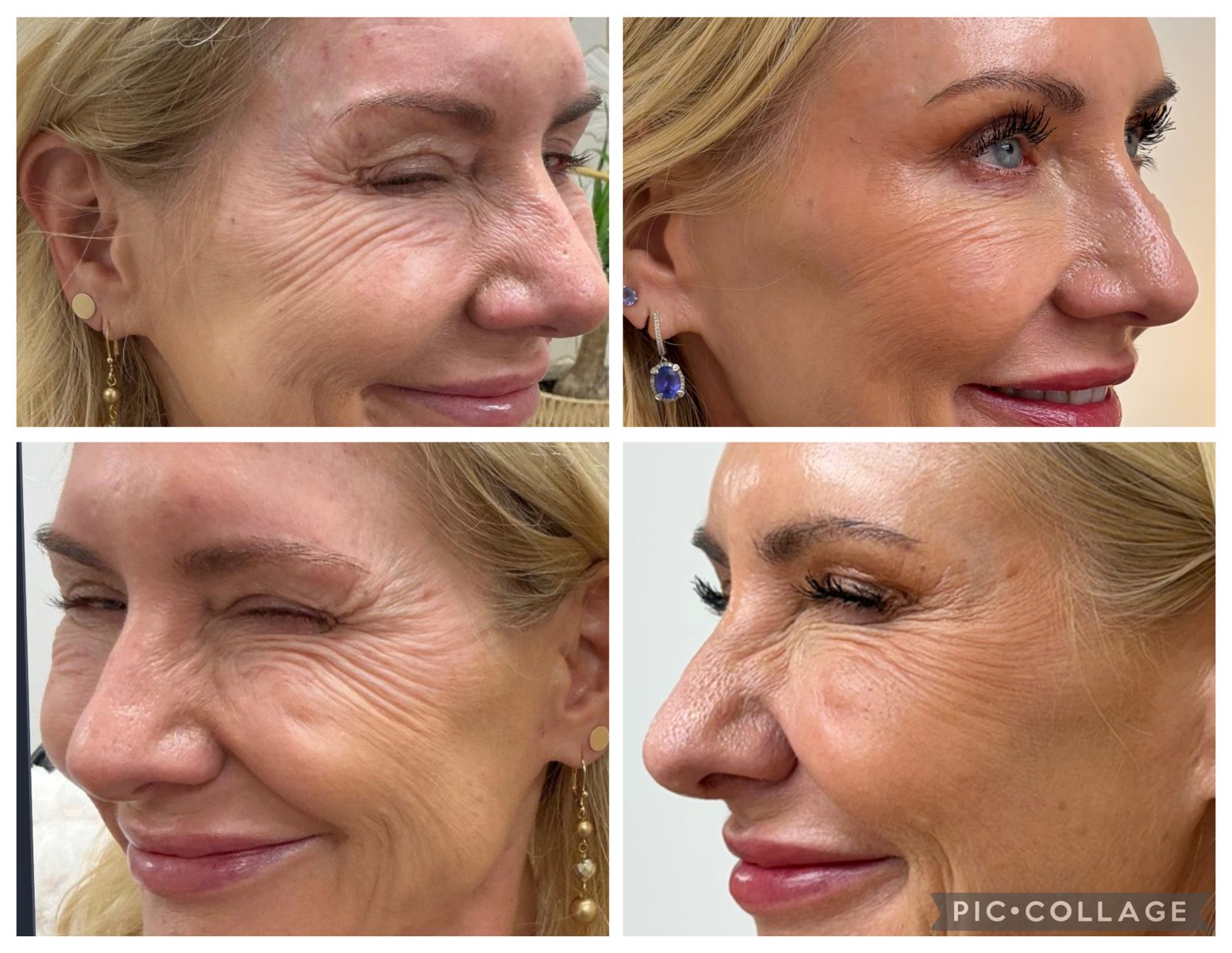 Before and after neurotoxin treatment of crow's feet and smile lines, shown in multiple angles