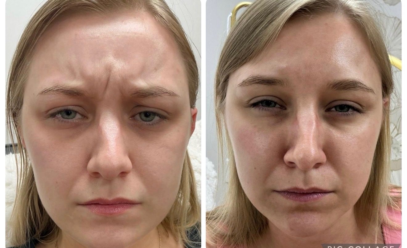 Before and after neurotoxin treatment of frown lines between the brows
