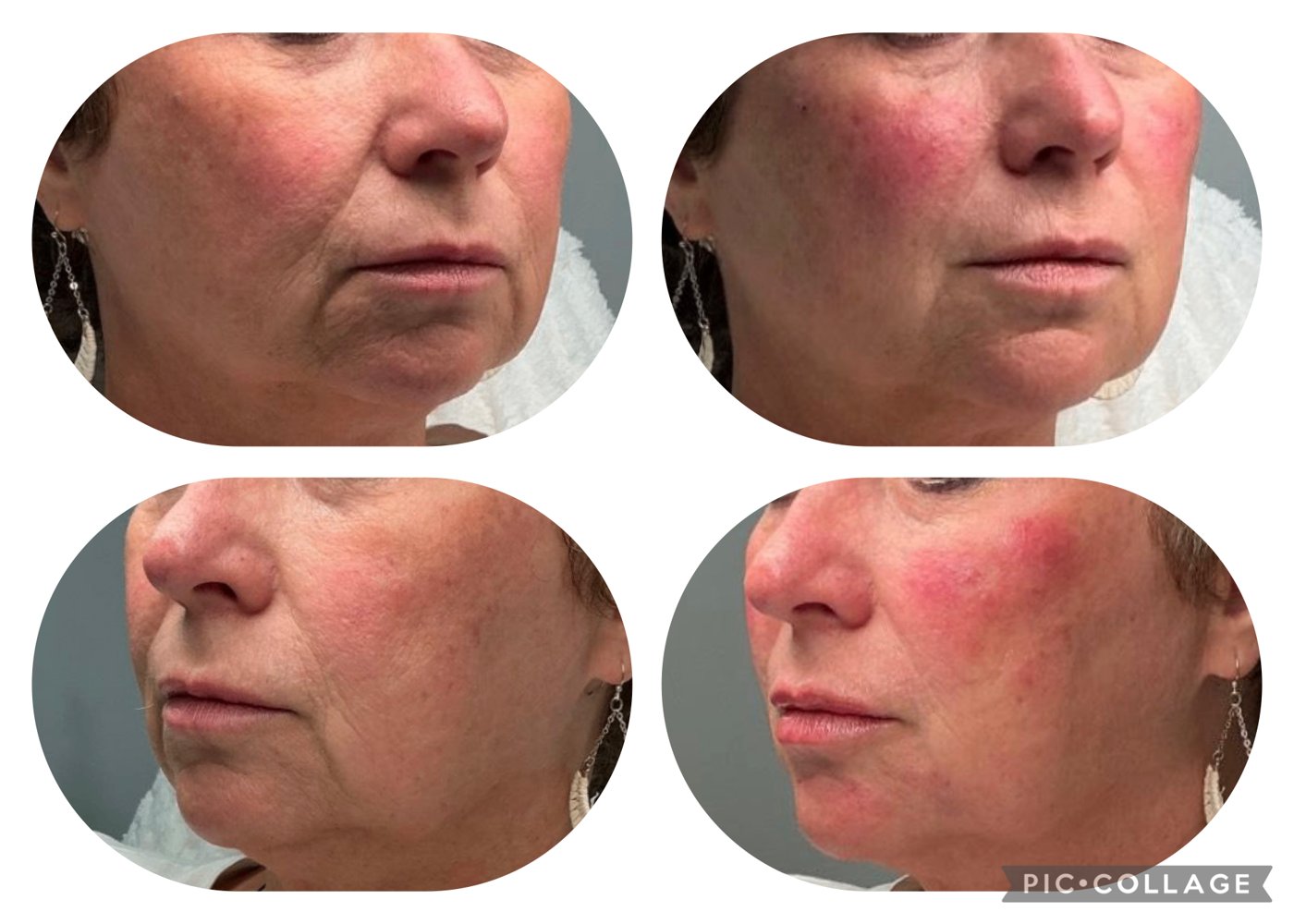 Before and after close-up, softened lines around the mouth and chin after treatment at TRU Integrative Wellness