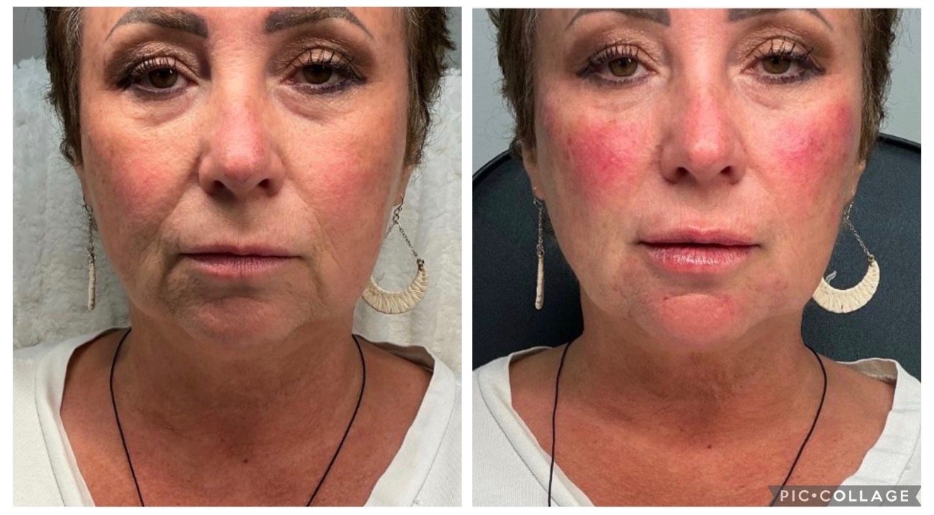 Before and after neurotoxin and aesthetic treatment, front view, TRU Integrative Wellness patient in Downers Grove, IL