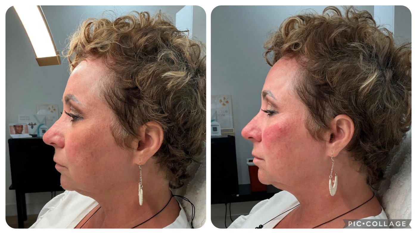 Before and after neurotoxin treatment, profile view showing smoother, more refreshed appearance