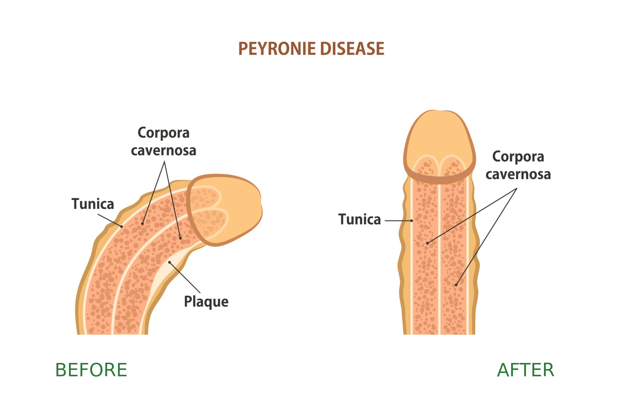 Before and after Peyronie's disease treatment showing curvature correction
