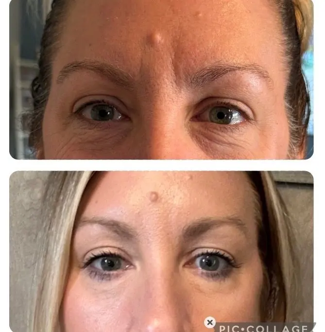 Before and after Xeomin treatment for forehead lines